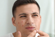 Basmi Jerawat Membandel Cukup Gunakan 3 Obat Ini