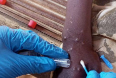 Beda Gejala Mpox yang Mewabah di Afrika dan Indonesia, Ini Penjelasan Dokter